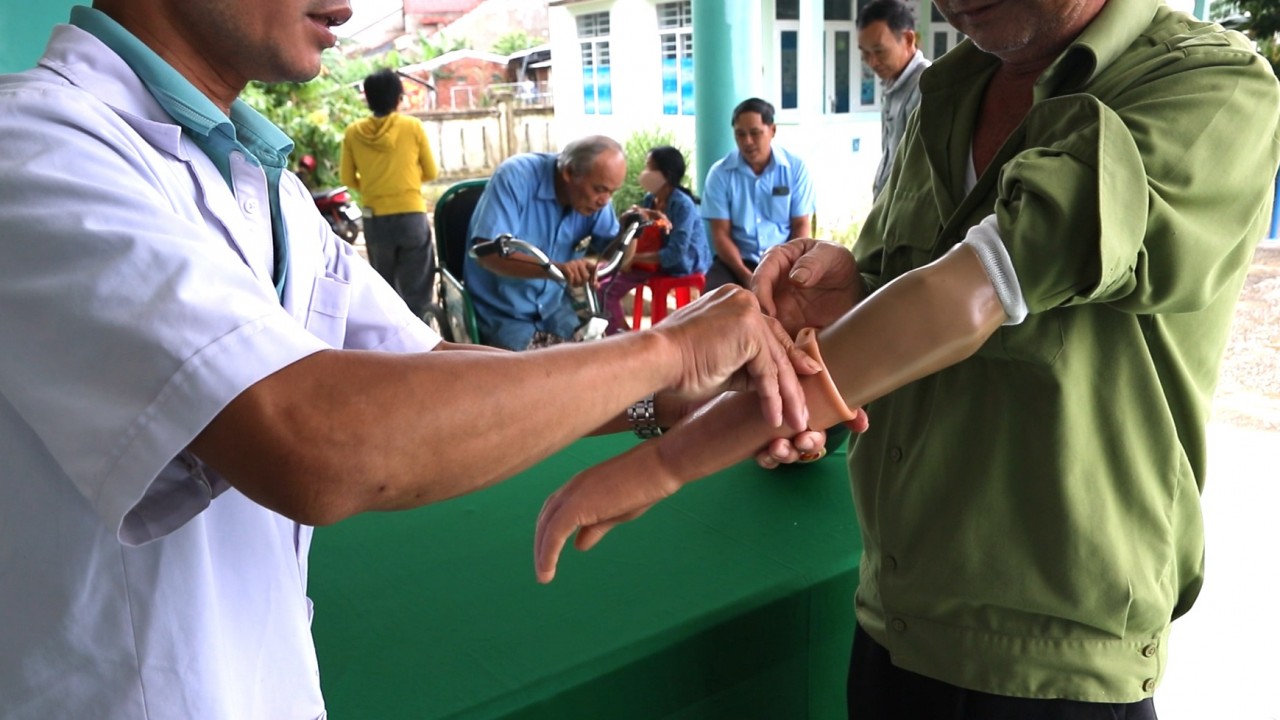 MCNV Assists People with Disabilities Get Access to Artificial Prosthetics, Orthotics