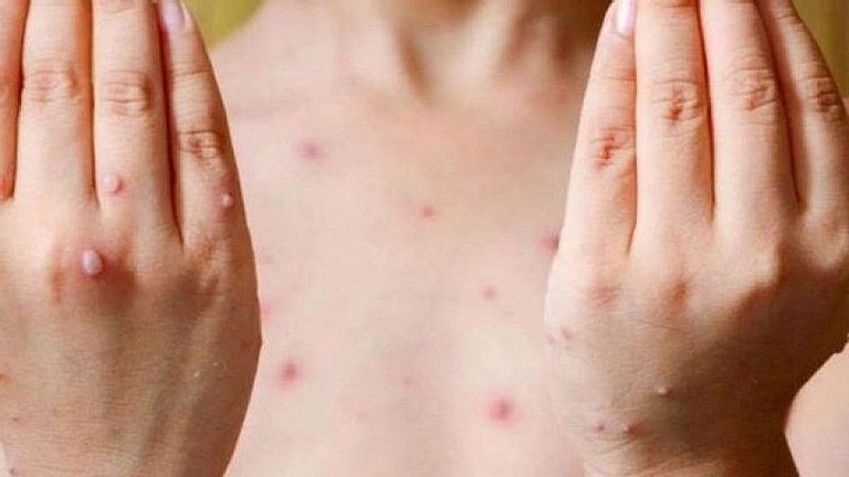 The Ministry of Health has warned about a possibly wider monkeypox outbreak during the winter-spring period. Illustrative photo.