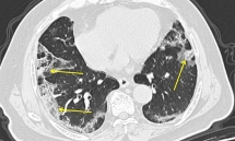 doctors not only lungs but other organs does coronavirus harm
