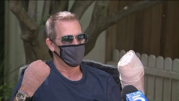 covid 19 survivor loses fingers after servere complications