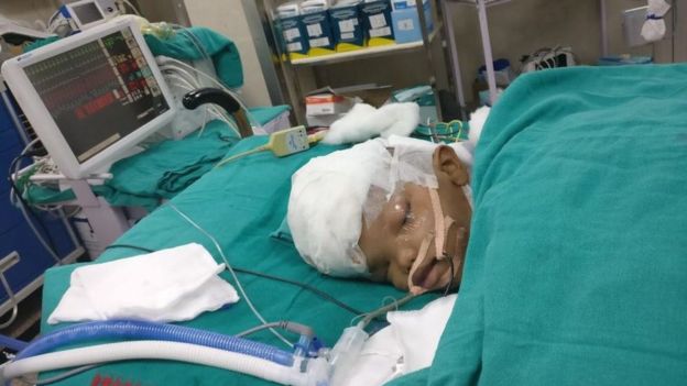India: Separated twin 'opens eyes' four days after surgery