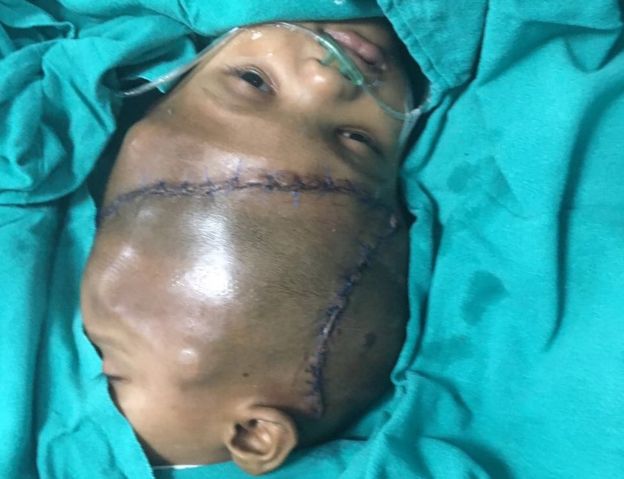 India: Separated twin 'opens eyes' four days after surgery